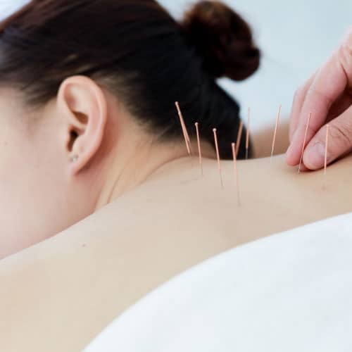 Acupuncture Upper Back