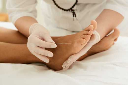 Getting acupuncture for foot pain
