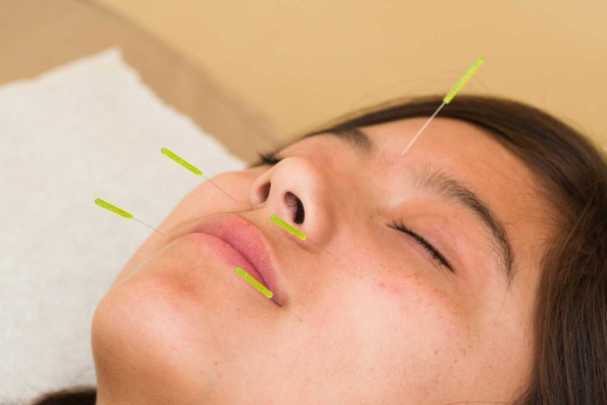 Acupuncture for Toothache Treatment